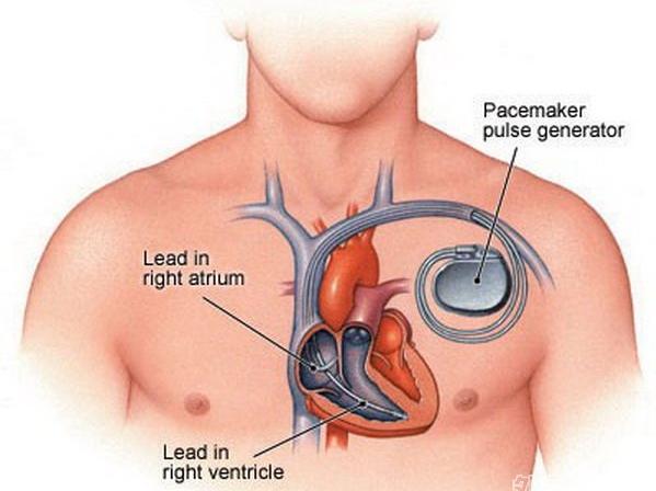 最新款起搏器，重塑心脏健康的新希望